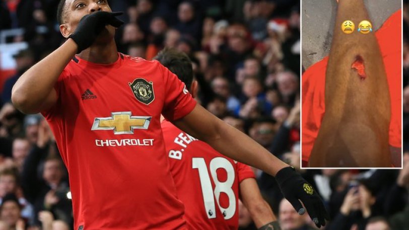 Premier League: Ο Μαρσιάλ μας δείχνει τις ανοιχτές πληγές στα πόδια του μετά τον τραυματισμό (pics & vid)) 